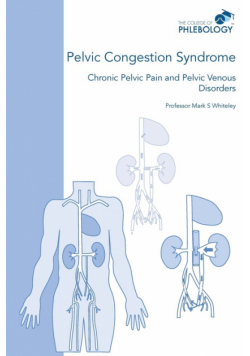 Pelvic Congestion Syndrome - Chronic Pelvic Pain and Pelvic Venous Disorders
