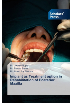 Implant as Treatment option in Rehabilitation of Posterior Maxilla