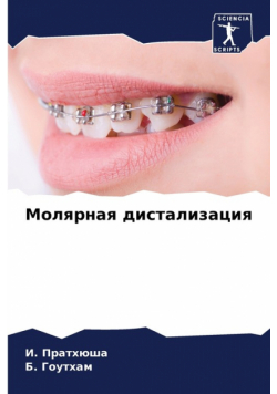 Молярная дистализация