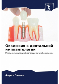Окклюзия в дентальной имплантологии