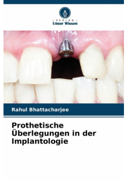 Prothetische Überlegungen in der Implantologie