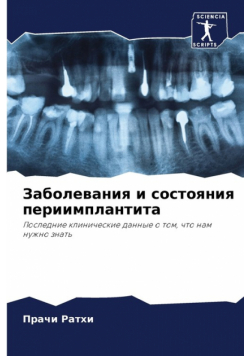Заболевания и состояния периимплантита