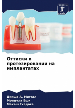 Оттиски в протезировании на имплантатах