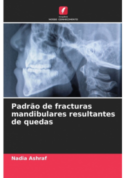 Padrão de fracturas mandibulares resultantes de quedas