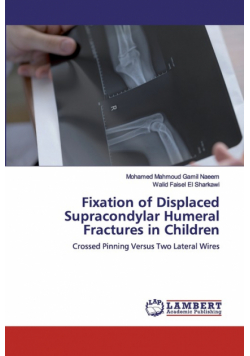 Fixation of Displaced Supracondylar Humeral Fractures in Children