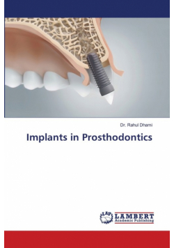 Implants in Prosthodontics