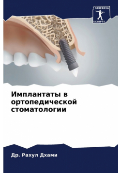 Имплантаты в ортопедической стоматологии