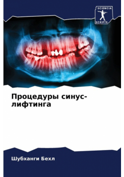 Процедуры синус-лифтинга