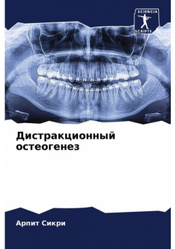 Дистракционный остеогенез