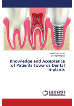 Knowledge and Acceptance of Patients Towards Dental Implants