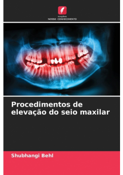 Procedimentos de elevação do seio maxilar