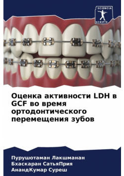 Оценка Активности Ldh В Gcf Во Время Ортодонтического Перемещения Зубов