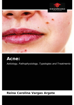Acne
