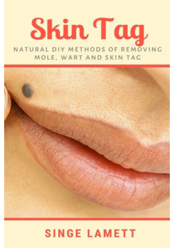 Skin Tag