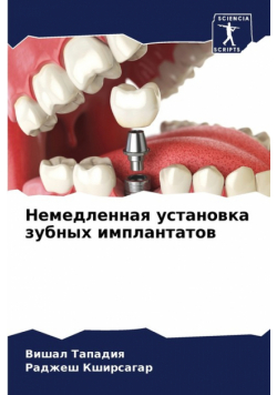 Немедленная установка зубных имплантатов