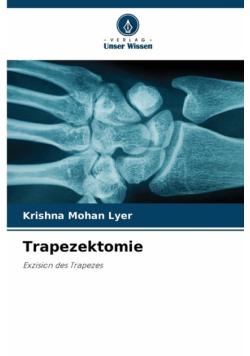Trapezektomie