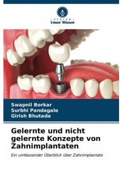 Gelernte und nicht gelernte Konzepte von Zahnimplantaten