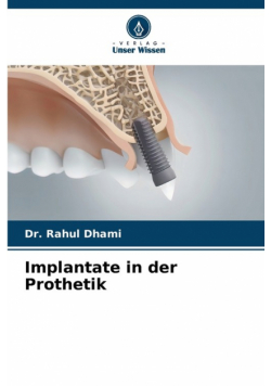 Implantate in der Prothetik