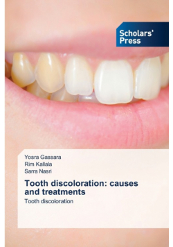 Tooth discoloration