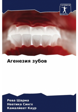 Агенезия зубов