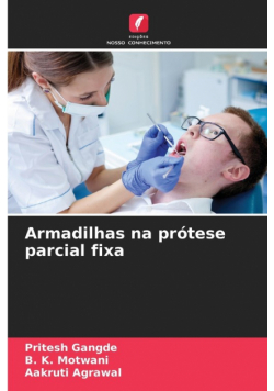 Armadilhas na prótese parcial fixa