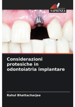 Considerazioni protesiche in odontoiatria implantare