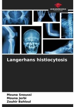 Langerhans histiocytosis