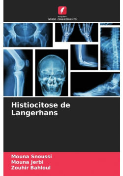 Histiocitose de Langerhans