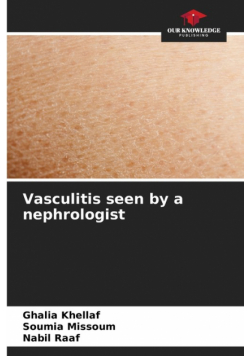 Vasculitis seen by a nephrologist