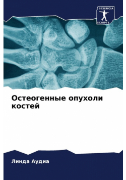 Остеогенные опухоли костей
