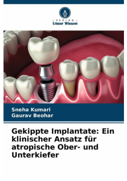 Gekippte Implantate