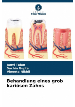 Behandlung eines grob kariösen Zahns