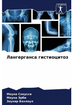 Лангерганса гистиоцитоз