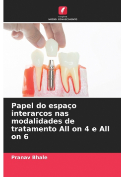 Papel do espaço interarcos nas modalidades de tratamento All on 4 e All on 6