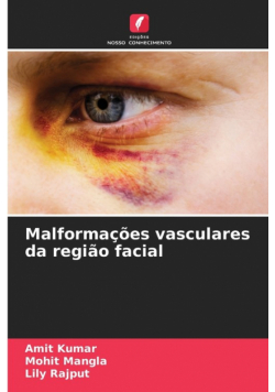Malformações vasculares da região facial