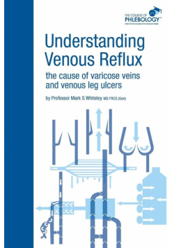 Understanding Venous Reflux the Cause of Varicose Veins and Venous Leg Ulcers