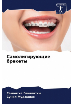 Самолигирующие брекеты