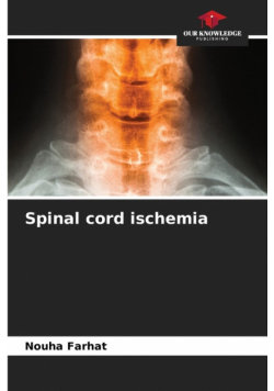 Spinal cord ischemia