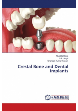 Crestal Bone and Dental Implants