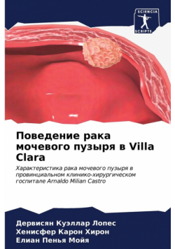 Поведение рака мочевого пузыря в Villa Clara