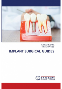 Implant Surgical Guides