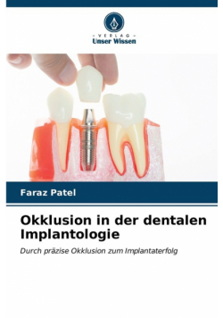 Okklusion in der dentalen Implantologie
