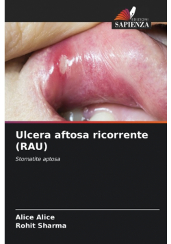 Ulcera aftosa ricorrente (RAU)
