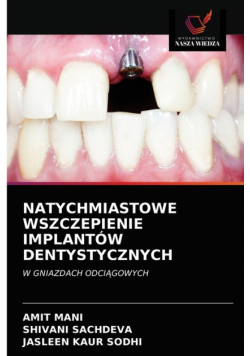 Natychmiastowe Wszczepienie Implantów Dentystycznych