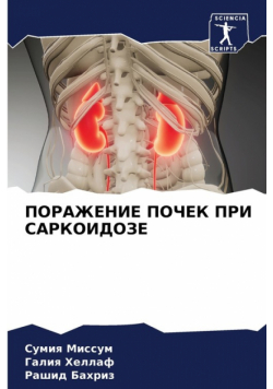 ПОРАЖЕНИЕ ПОЧЕК ПРИ САРКОИДОЗЕ