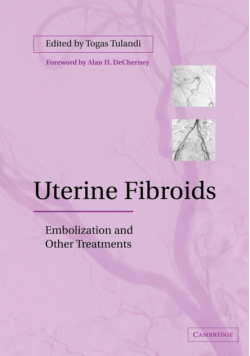 Uterine Fibroids